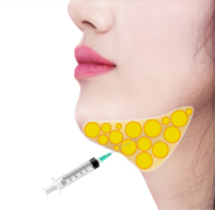 턱 밑 지방에 C-시스템 지방파괴주사 시술