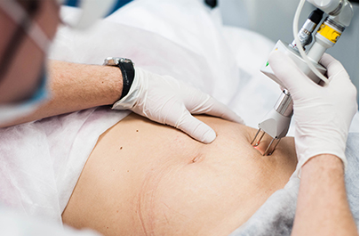 CO2 핀홀 요법 (CO2 Pin hole Therapy)